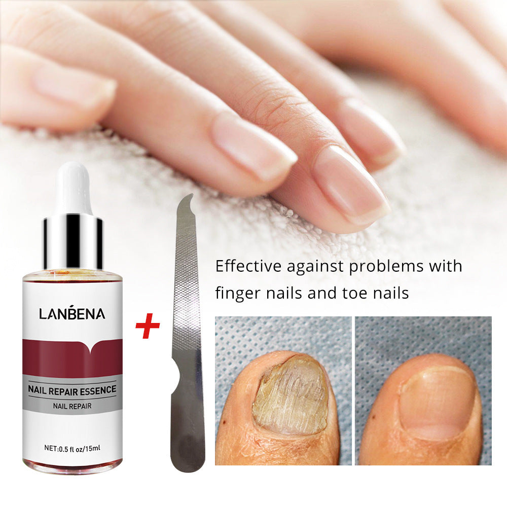 Nail Repair With Small File Anti-Onychomycosis Foot