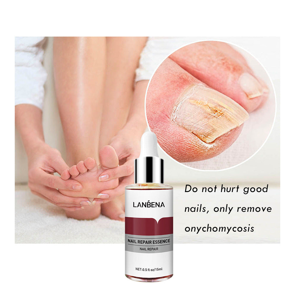 Nail Repair With Small File Anti-Onychomycosis Foot